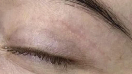 Фото ПОСЛЕ процедуры: Послеоперационные рубцы