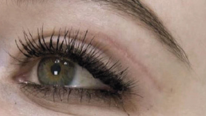 Фото ПОСЛЕ процедуры: Послеоперационные рубцы