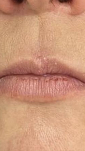 Фото ПОСЛЕ процедуры: Укушенная рана верхней губы