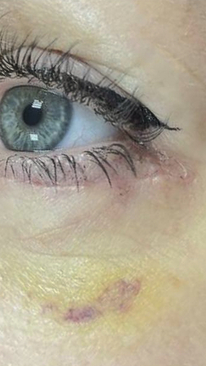 Фото ДО процедуры: Реабилитация после блефаропластики