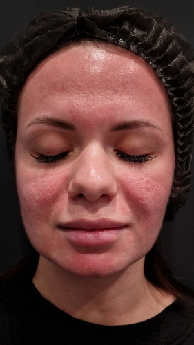 Фото ДО процедуры: После игольчатого RF