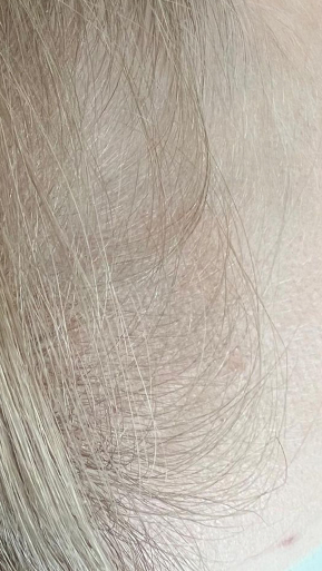 Фото ДО процедуры: Выпадение волос