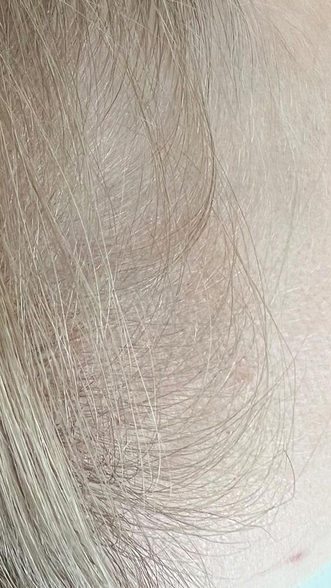 Фото ДО процедуры: Выпадение волос