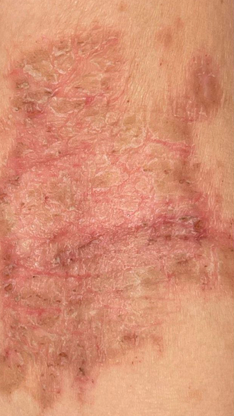 Фото ДО процедуры: Атопический дерматит