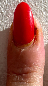 Фото ПОСЛЕ процедуры: Панариций