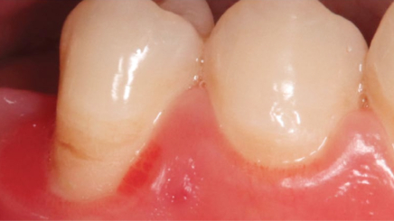 Фото ПОСЛЕ процедуры: Хронический пародонтит средней степени тяжести