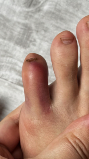 Фото ДО процедуры: Реабилитация после травмы