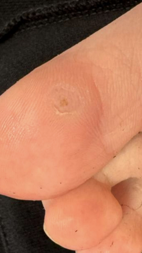 Фото ПОСЛЕ процедуры: Подошвенные бородавки