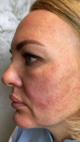 Фото ДО процедуры: Отёк после RF