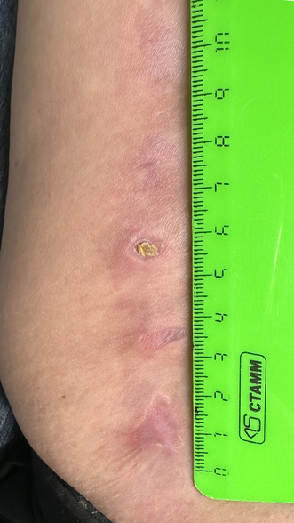 Фото ПОСЛЕ процедуры: Лазерный ожог