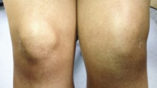 Фото ПОСЛЕ процедуры: Рецидивирующий синовит коленного сустава