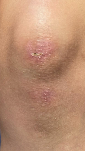 Фото ПОСЛЕ процедуры: Реабилитация после падения