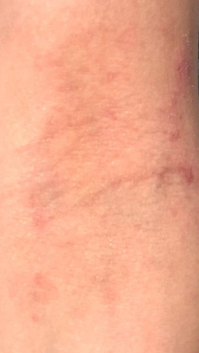 Фото ПОСЛЕ процедуры: Атопический дерматит
