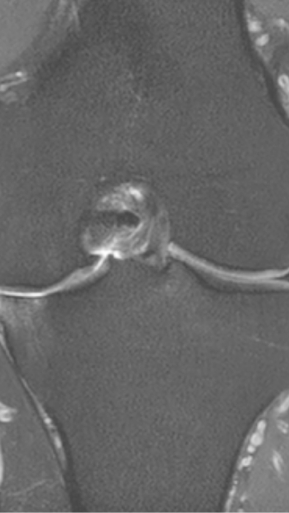 Фото ПОСЛЕ процедуры: Асептический некроз коленного сустава