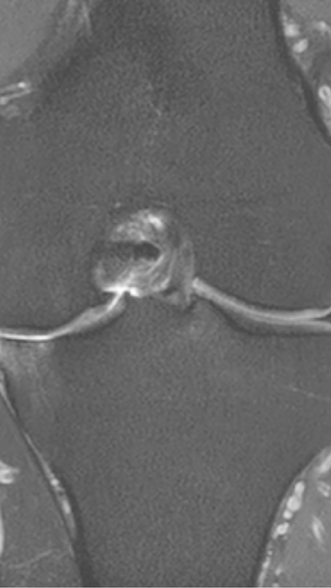 Фото ПОСЛЕ процедуры: Асептический некроз коленного сустава