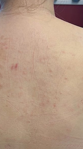 Фото ПОСЛЕ процедуры: Крапивница