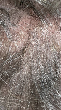 Фото ДО процедуры: Псориаз волосистой части головы