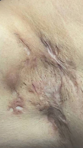 Фото ПОСЛЕ процедуры: Гидраденит осложненный