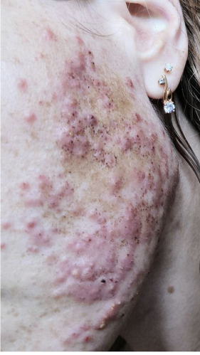 Фото ДО процедуры: Розацеа