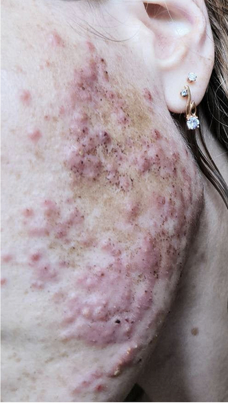 Фото ДО процедуры: Розацеа