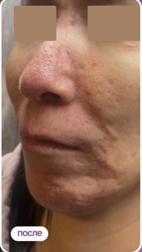 Фото ПОСЛЕ процедуры: Акне и розацеа