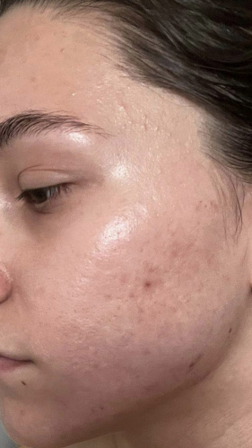 Фото ПОСЛЕ процедуры: Постакне и рубцы