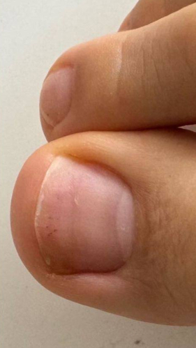 Фото ПОСЛЕ процедуры: Онихолизис