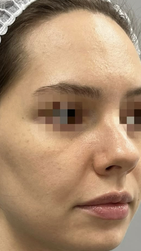 Фото ПОСЛЕ процедуры: Улучшение качества кожи