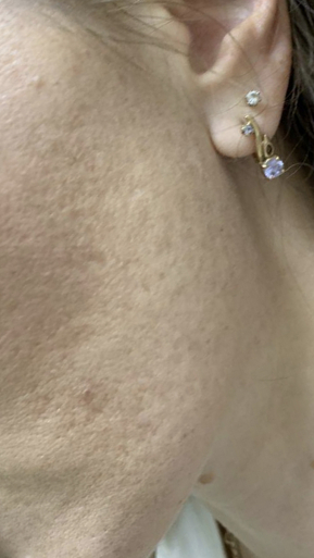 Фото ПОСЛЕ процедуры: Розацеа