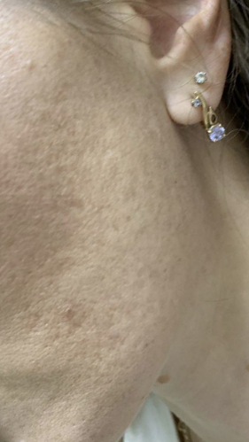 Фото ПОСЛЕ процедуры: Розацеа