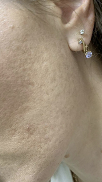 Фото ПОСЛЕ процедуры: Розацеа