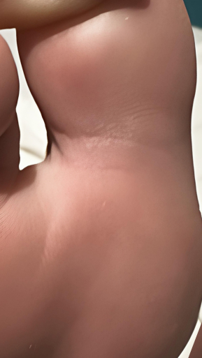 Фото ПОСЛЕ процедуры: Подошвенные бородавки