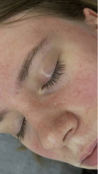 Фото ПОСЛЕ процедуры: Снятие обострения розацеа