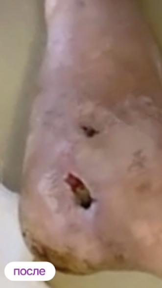 Фото ПОСЛЕ процедуры: Политравма стопы