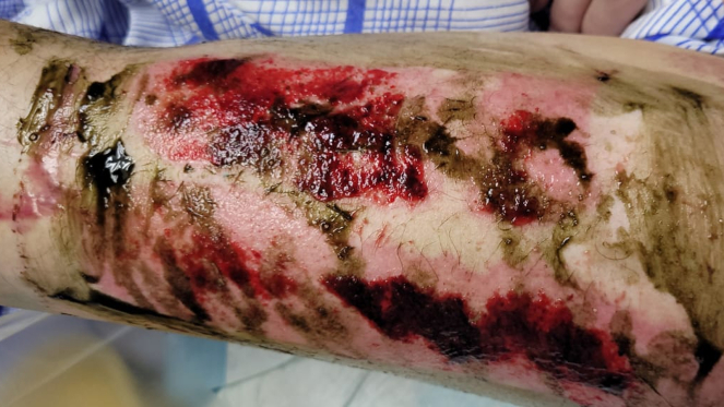 Фото ПОСЛЕ процедуры: Восстановление кожи предплечья