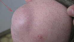 Фото ПОСЛЕ процедуры: Рецидивирующий бурсит коленного сустава