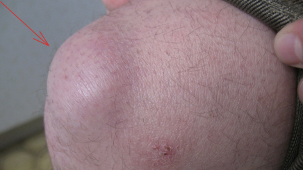 Фото ПОСЛЕ процедуры: Рецидивирующий бурсит коленного сустава