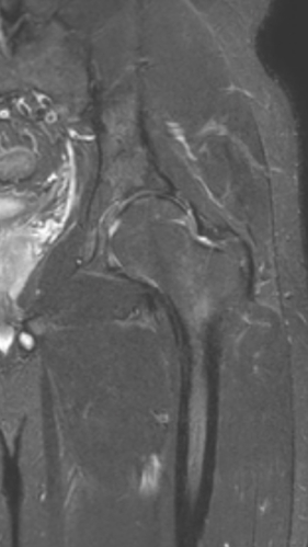 Фото ПОСЛЕ процедуры: Асептический некроз тазобедренного сустава