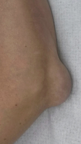 Фото ПОСЛЕ процедуры: Рецидивирующий синовит сустава