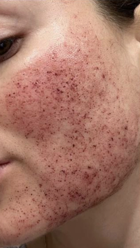 Фото ДО процедуры: Реабилитация после СО2 лазерной шлифовки