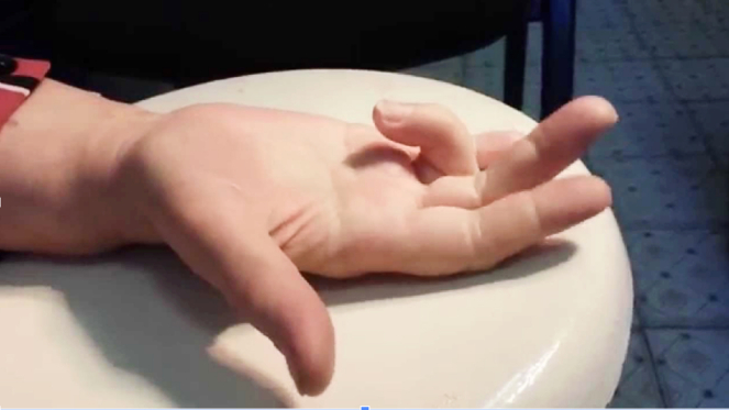 Фото ПОСЛЕ процедуры: Болезнь Нотта