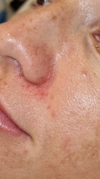 Фото ДО процедуры: Периоральный дерматит