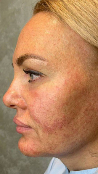 Фото ПОСЛЕ процедуры: Отёк после RF