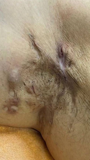 Фото ДО процедуры: Гидраденит осложненный