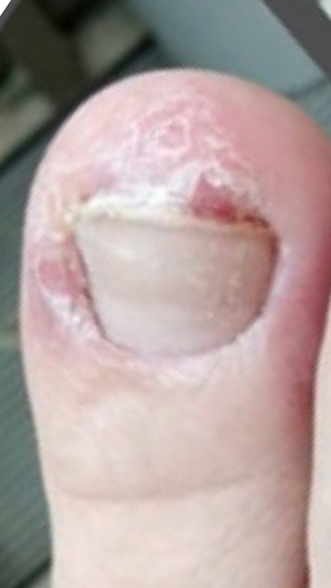 Фото ДО процедуры: Ониходистрофия