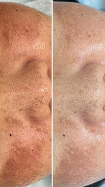 Фото ПОСЛЕ процедуры: Пигментация