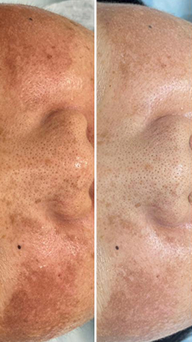 Фото ПОСЛЕ процедуры: Пигментация