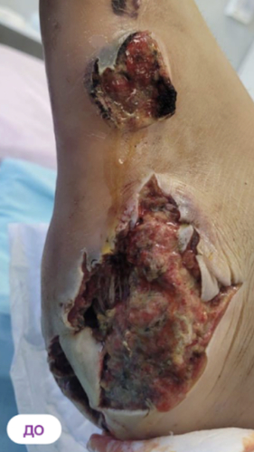 Фото ДО процедуры: Политравма стопы