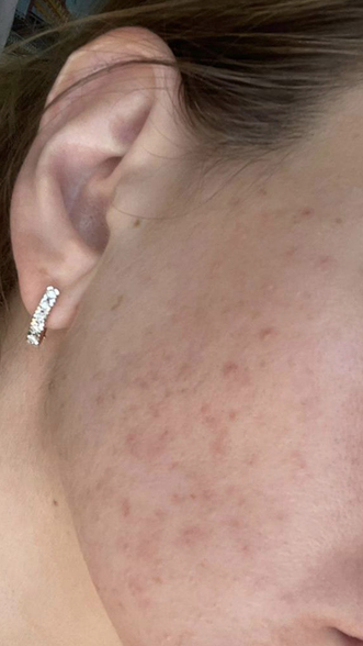 Фото ПОСЛЕ процедуры: Акне