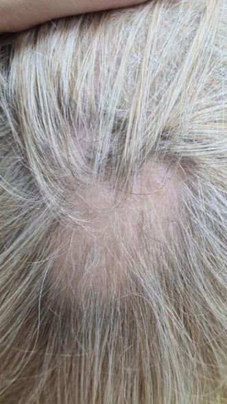 Фото ДО процедуры: Очаговая алопеция